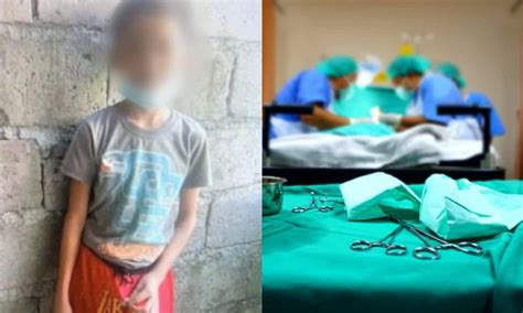 6 Mga Pagkakaiba sa pagitan ng Tuli at Hindi Tuli na Ari .